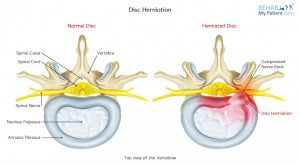 Fazele herniei de disc